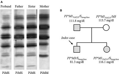 Molecular characterization of PI*Shangzhou, a SERPINA1 allele from continental China encoding a defective alpha-1-antitrypsin